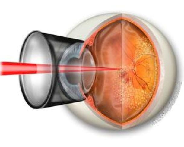 laser Argon