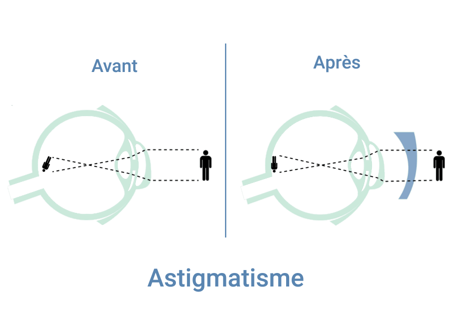Astigmatisme