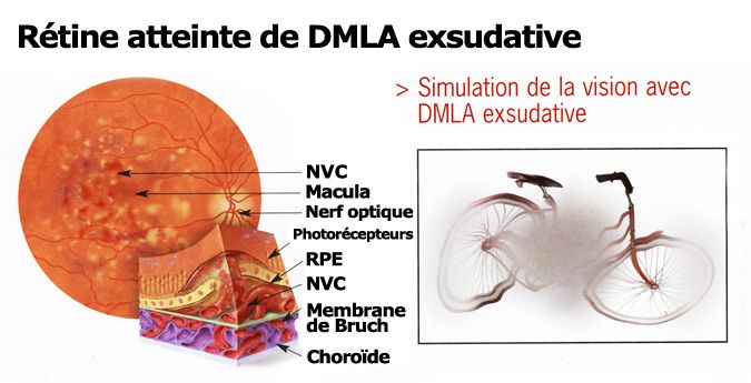 dmla sèche