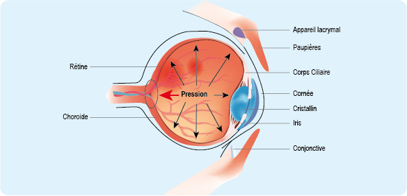 Glaucome