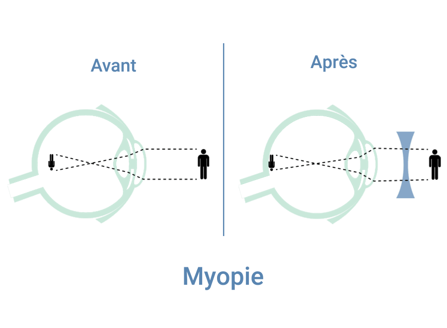myopie