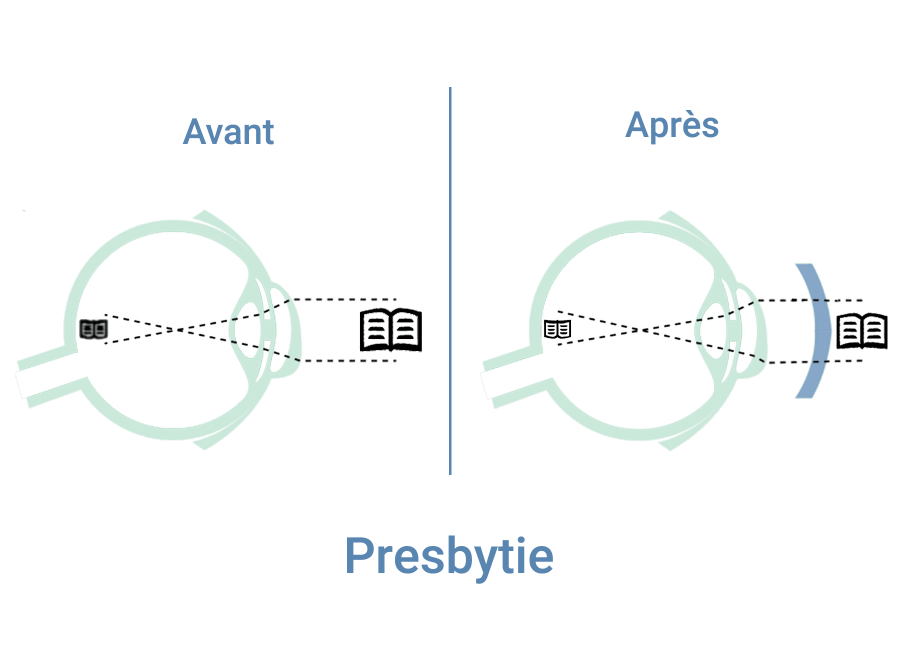 Presbytie