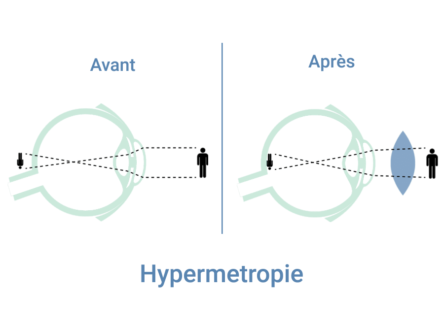 hypermetropie