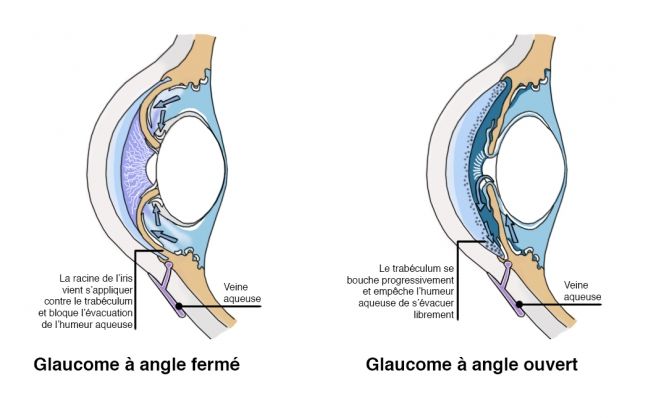 glaucome angles
