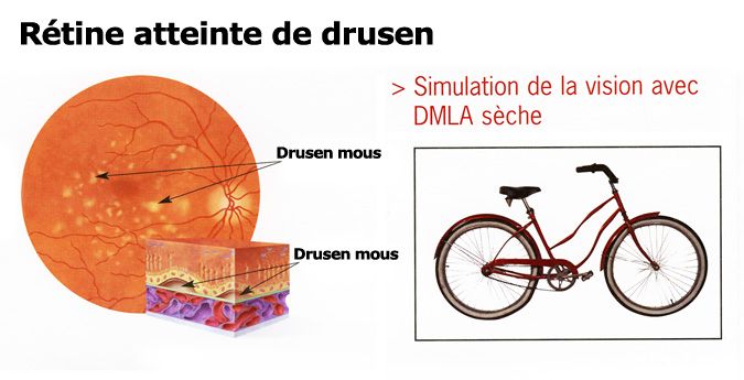 dmla sèche